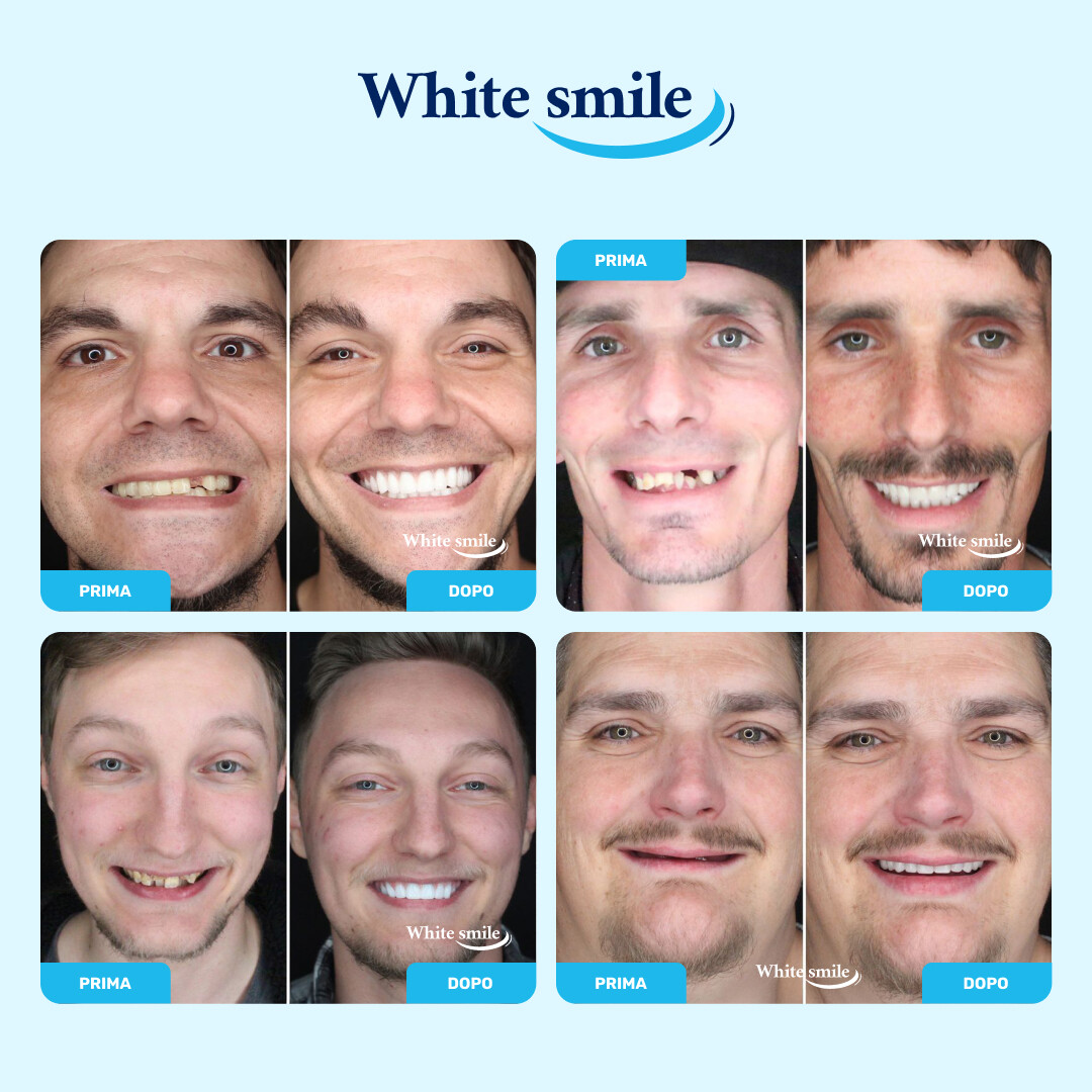 WHITESMILE™ – Faccetta Dentale Cosmetica Regolabile - immagine 3