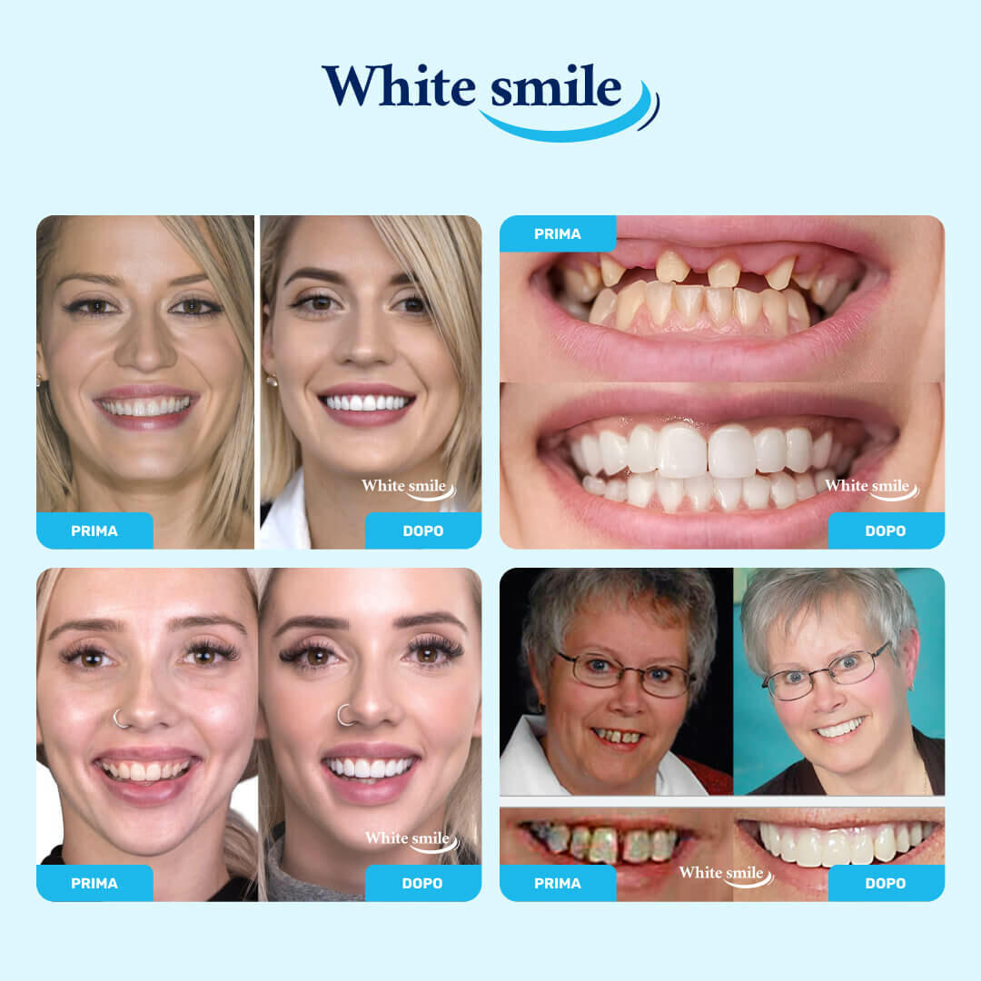 WHITESMILE™ – Faccetta Dentale Cosmetica Regolabile - immagine 2